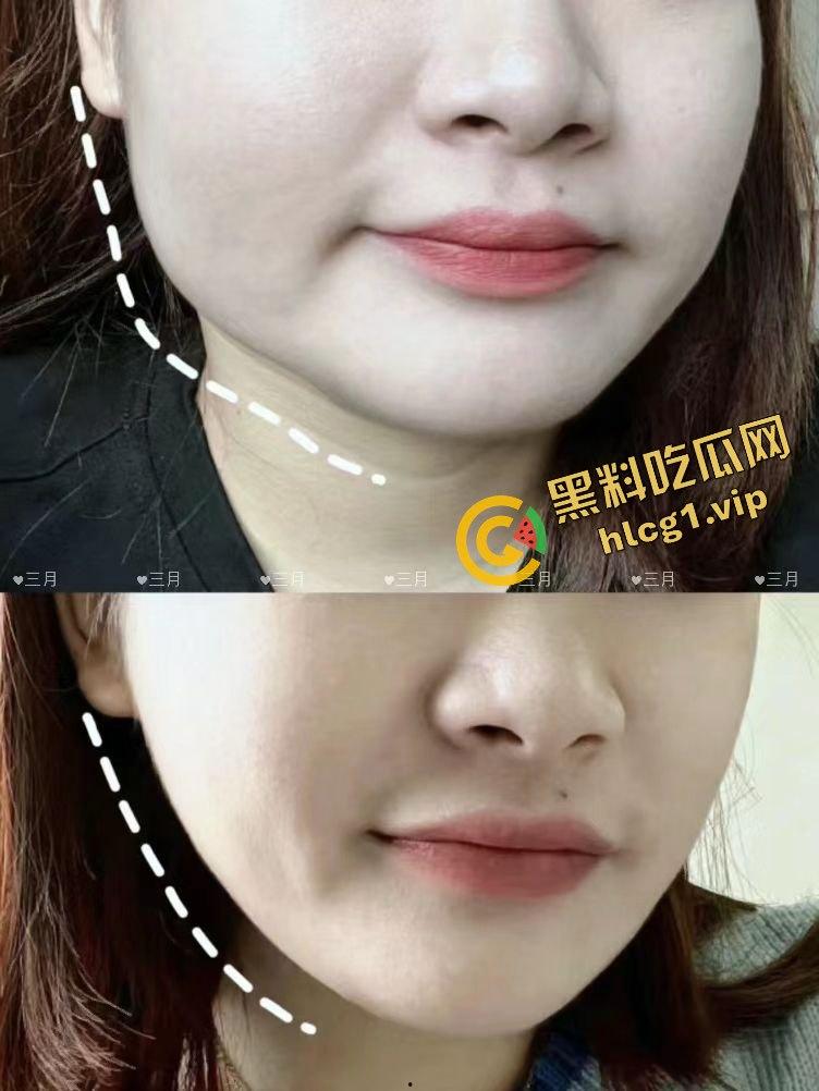 每个人体质不一样!瘦脸医美针害死人!肉毒整容 那女的 变 那女神!-12