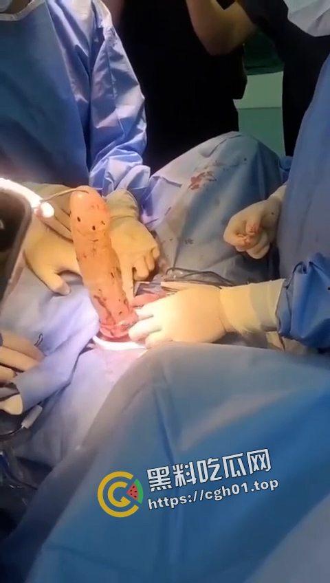 活久见!超大假阳具塞进体内拿不出来只能做手术 你们男同玩的都这么狠吗-3